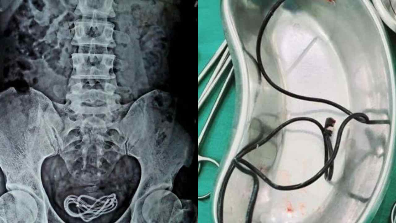 Man Inserts Mobile Charging Cable In Urinary Bladder
